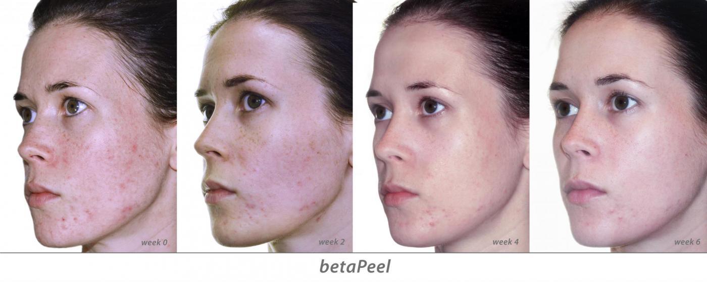 profile peels wk0 wk6